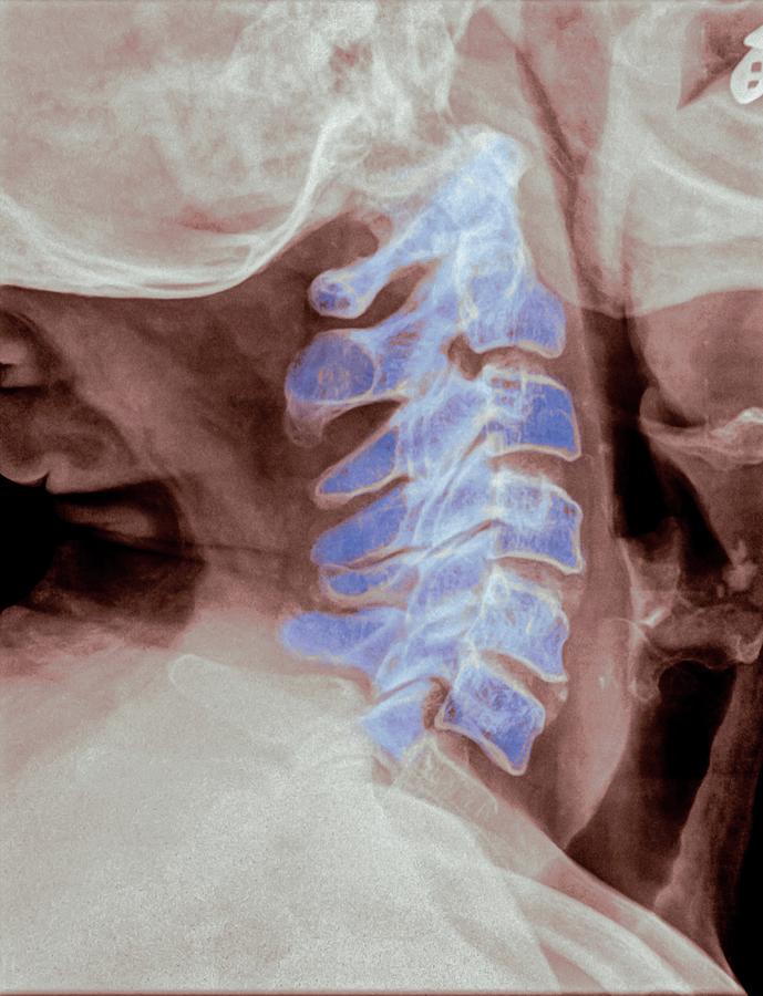 Normal Cervical Spine X-ray Of A 70 Photograph by PhotoStock-Israel ...