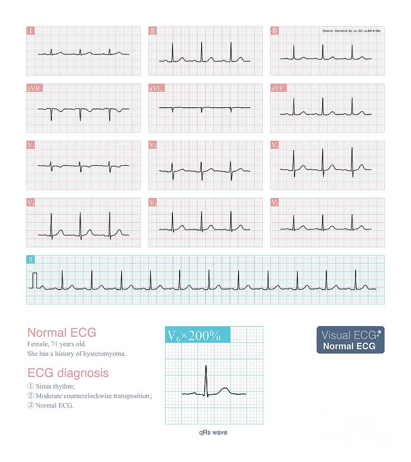 Normal Ecg Photograph by Chongqing Tumi Technology Ltd/science Photo Library
