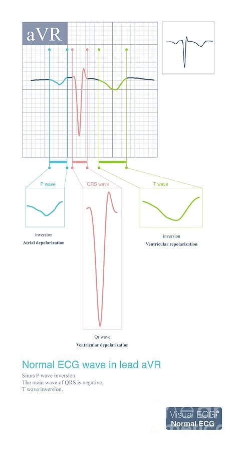 Normal Ecg Wave In Avr Lead Photograph by Chongqing Tumi Technology Ltd ...