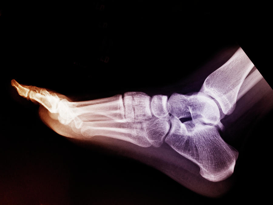Normal Foot X-ray Of A 17 Year Old Woman Digital Art by Callista Images ...