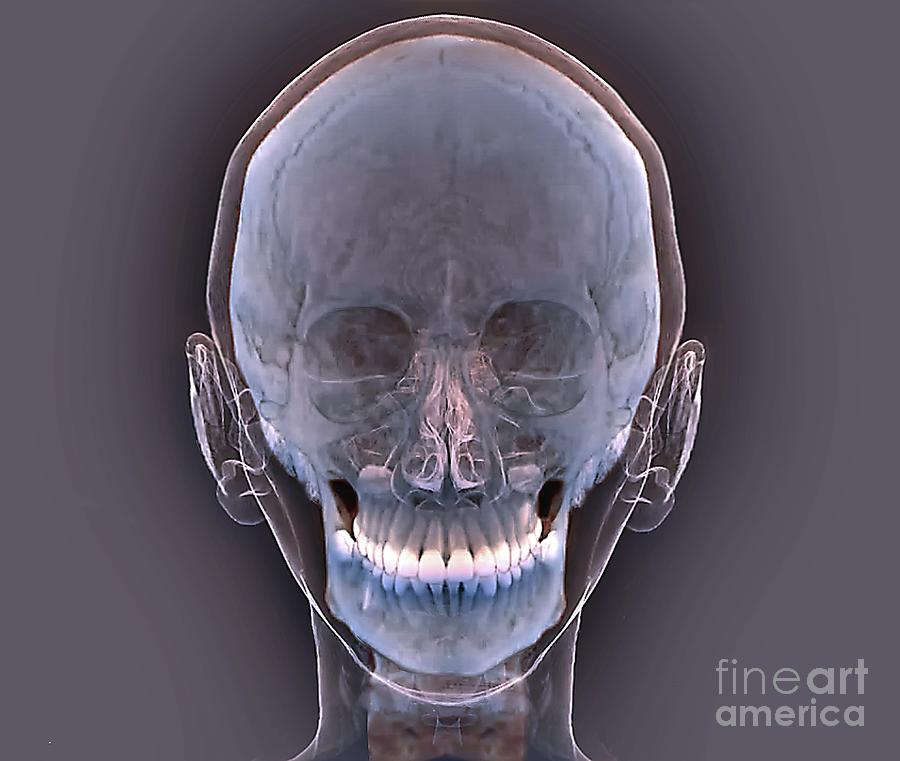 Normal Human Skull Photograph by Zephyr/science Photo Library - Pixels