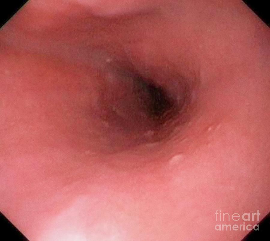 Nobody Photograph - Normal Oesophagus by Gastrolab/science Photo Library