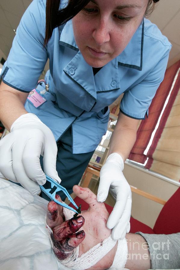 Nurse Using A Medicinal Leech On Patient Photograph by Louise Murray/science Photo Library