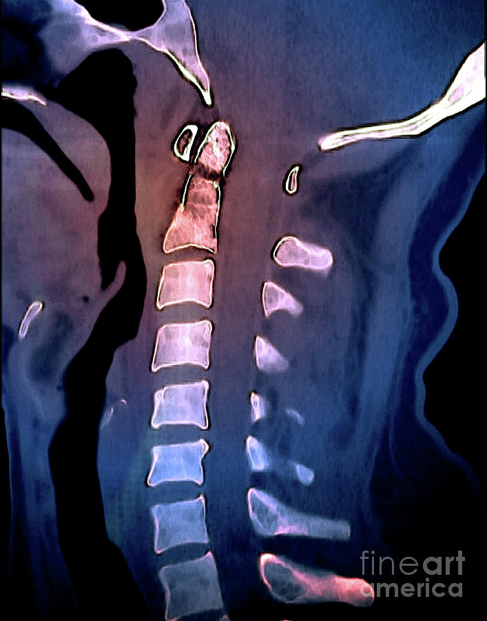 Odontoid Process Fracture Photograph by Zephyr/science Photo Library