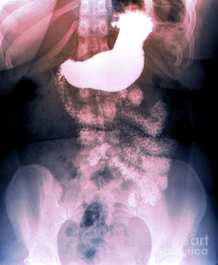 Oeso-gastrointestinal Duodenal Transit Photograph by Zephyr/science Photo Library