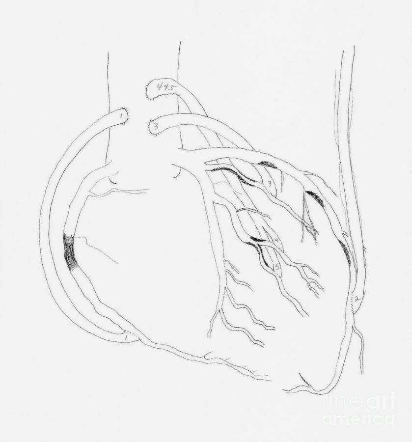 Open Heart Surgery Photograph