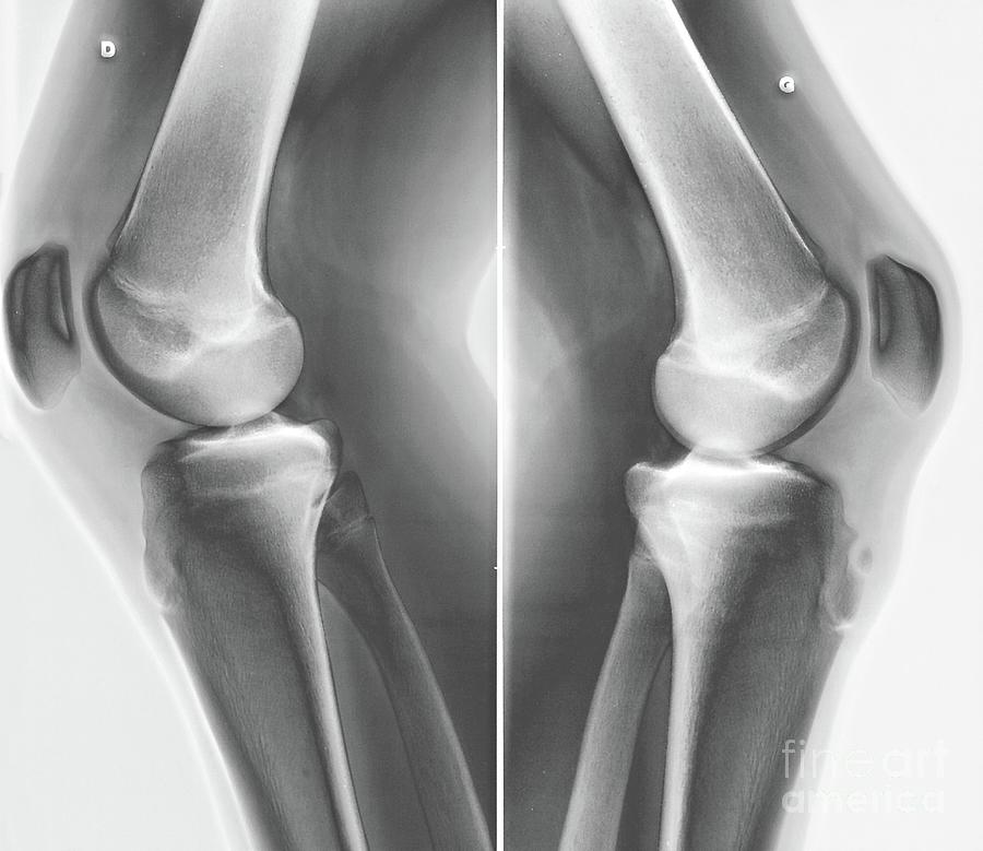 Black And White Photograph - Osgood-schlatter Disease by Zephyr/science Photo Library