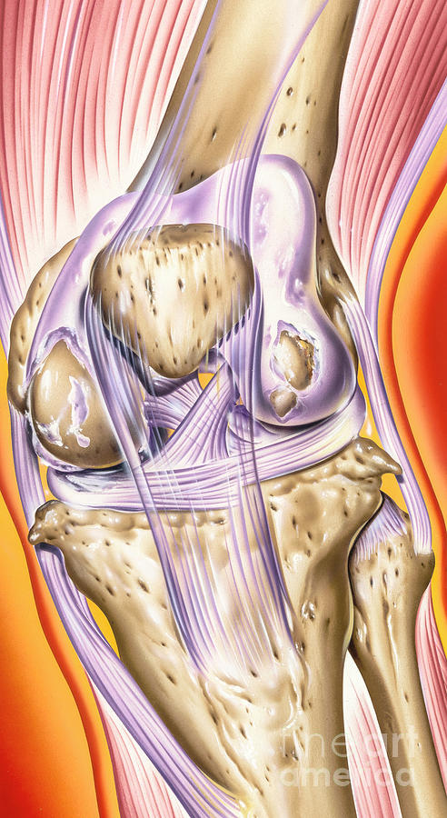 Osteoarthritis Of The Knee Photograph by John Bavosi/science Photo Library