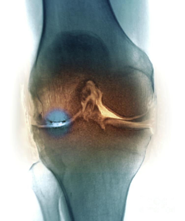 58 Photograph - Osteoarthritis Of The Knee Joint by Zephyr/science Photo Library
