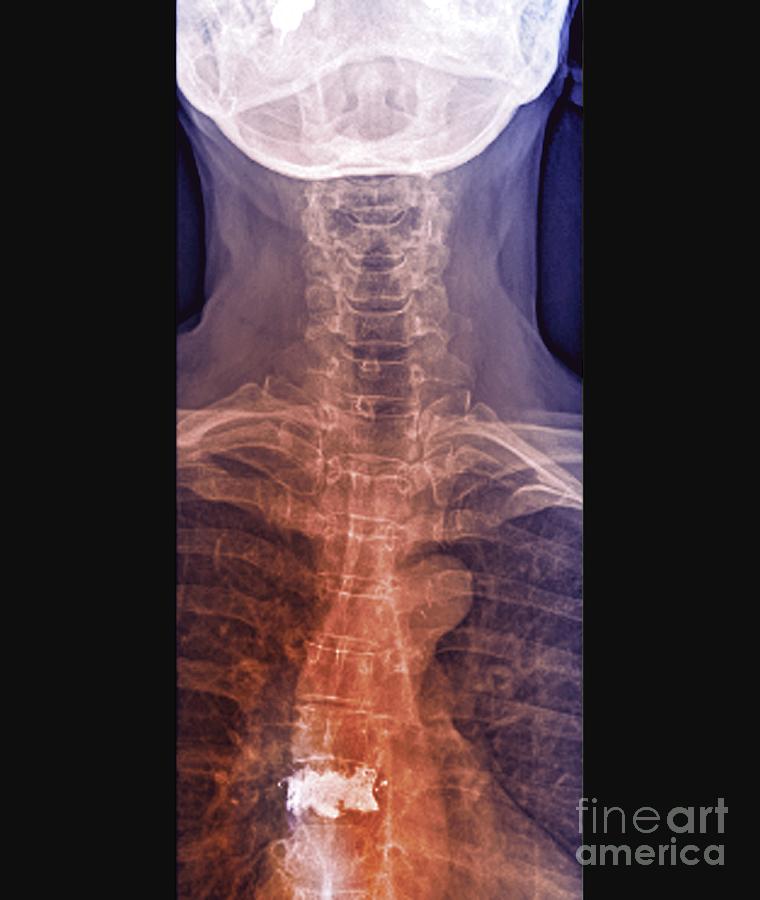 Osteoporosis Of The Spine With Vertebroplasty by Zephyr/science Photo ...