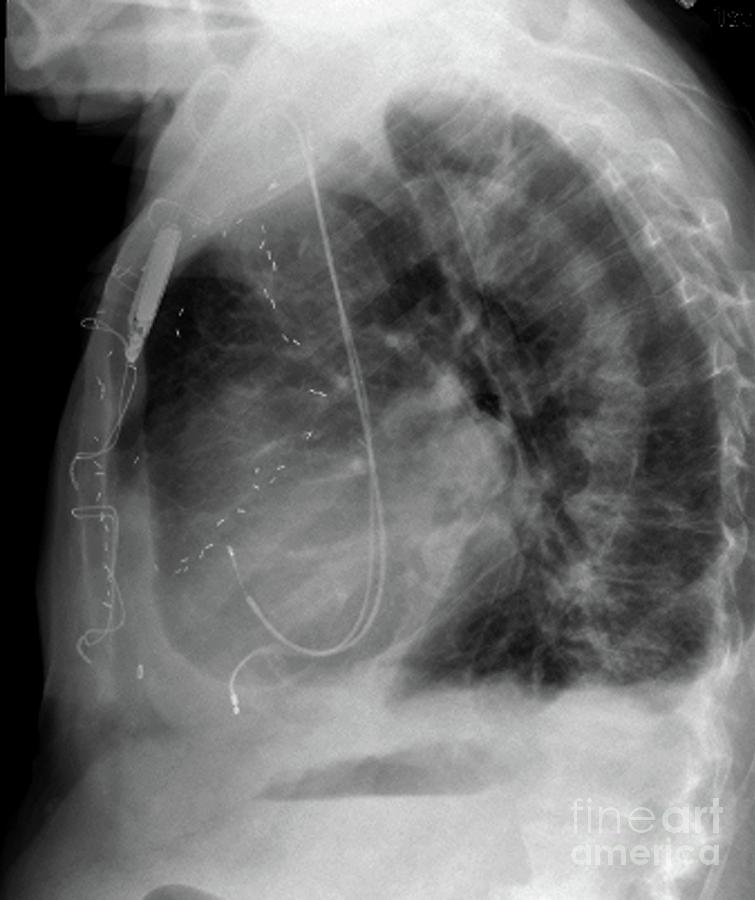 Pacemaker And Coronary Bypass Surgical Clips Photograph by Zephyr