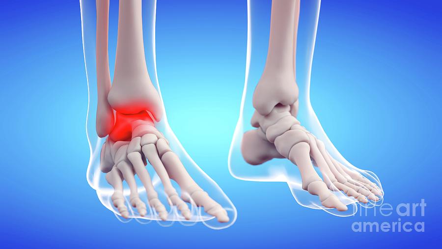 Painful Ankle Joint Photograph By Sebastian Kaulitzki Science Photo 