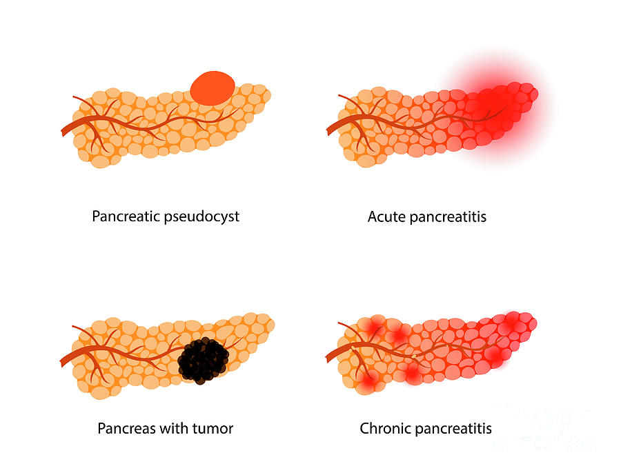 Pancreatic Diseases Photograph by Pikovit / Science Photo Library