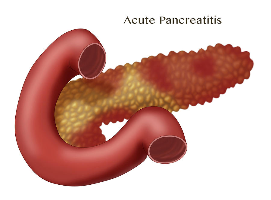 Pancreatitis, Illustration Photograph by Monica Schroeder