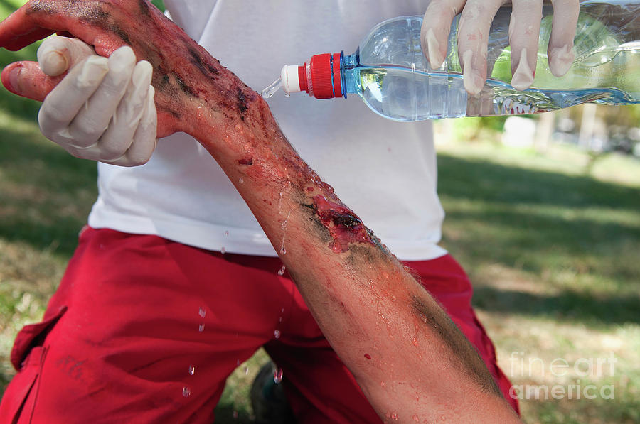 Bottle Photograph - Paramedic Cooling Third Degree Burns With Water by Microgen Images/science Photo Library