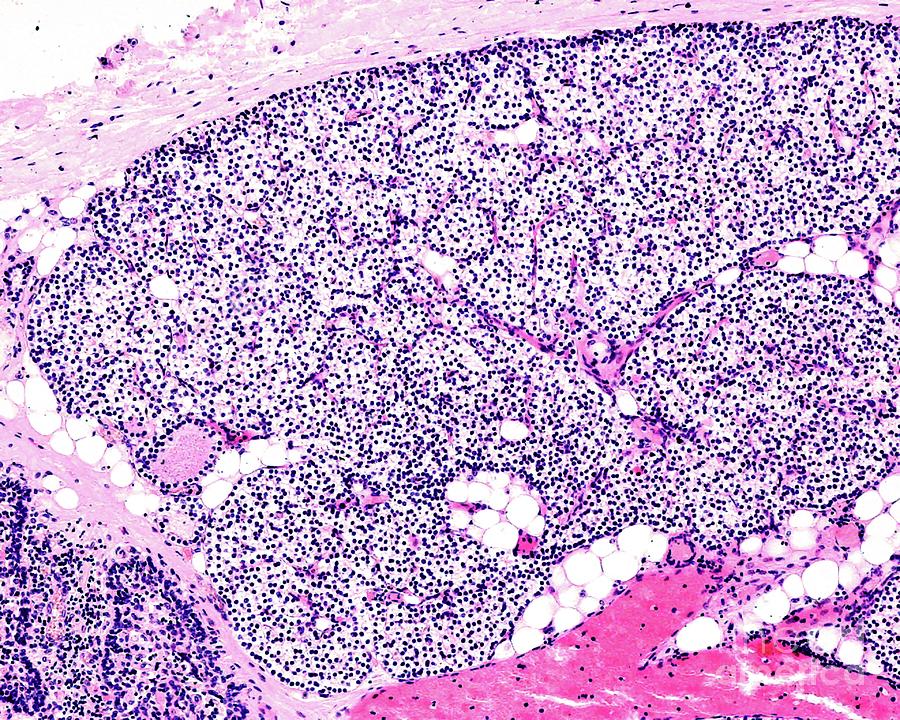 Parathyroid Gland Of A Child Photograph by Jose Calvo / Science Photo ...