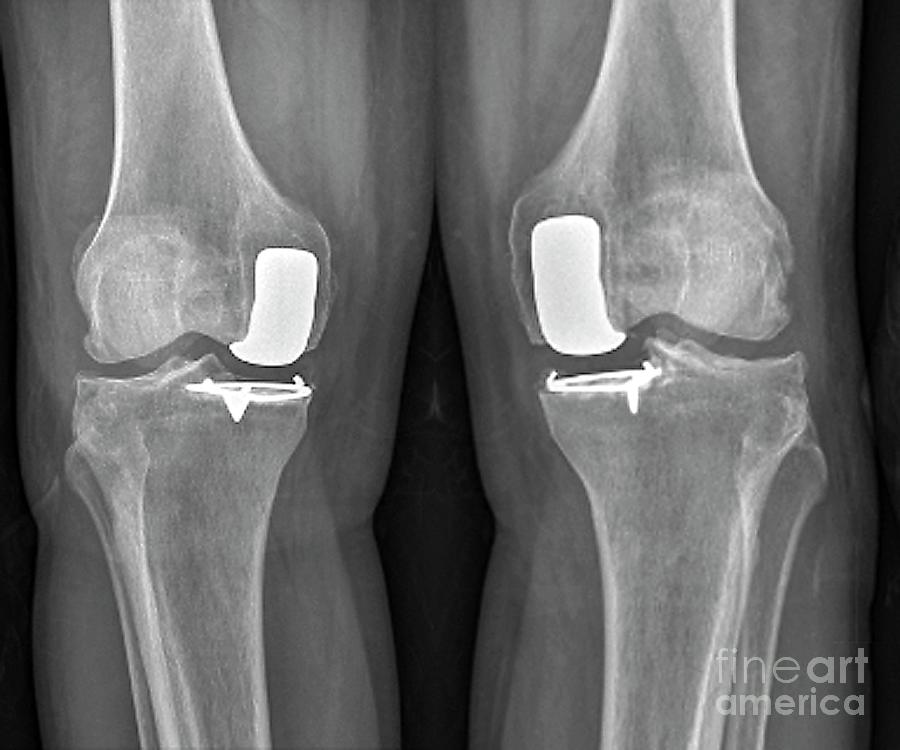 Partial Knee Replacement Photograph by Zephyr/science Photo Library
