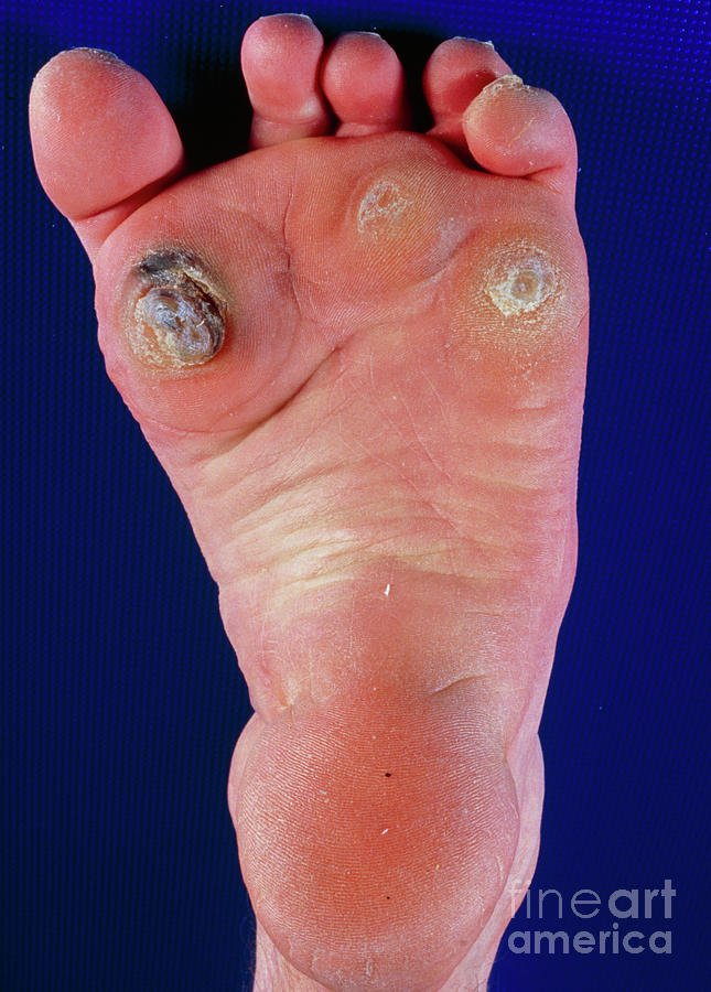 Patient Affected By Claw-toes Photograph by Princess Margaret Rose Orthopaedic Hospital/science Photo Library