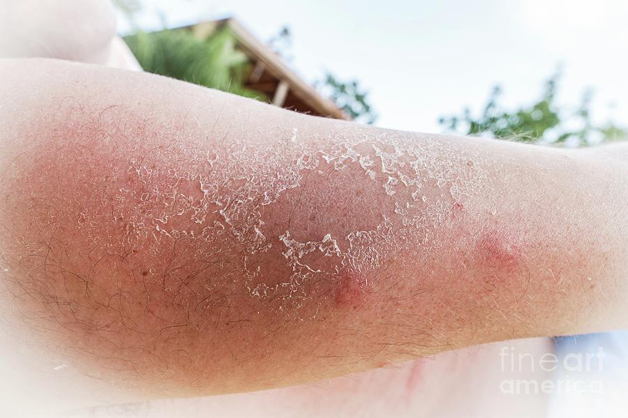 Peeling Skin Due To Sun Burn Photograph by Gustoimages/science Photo ...