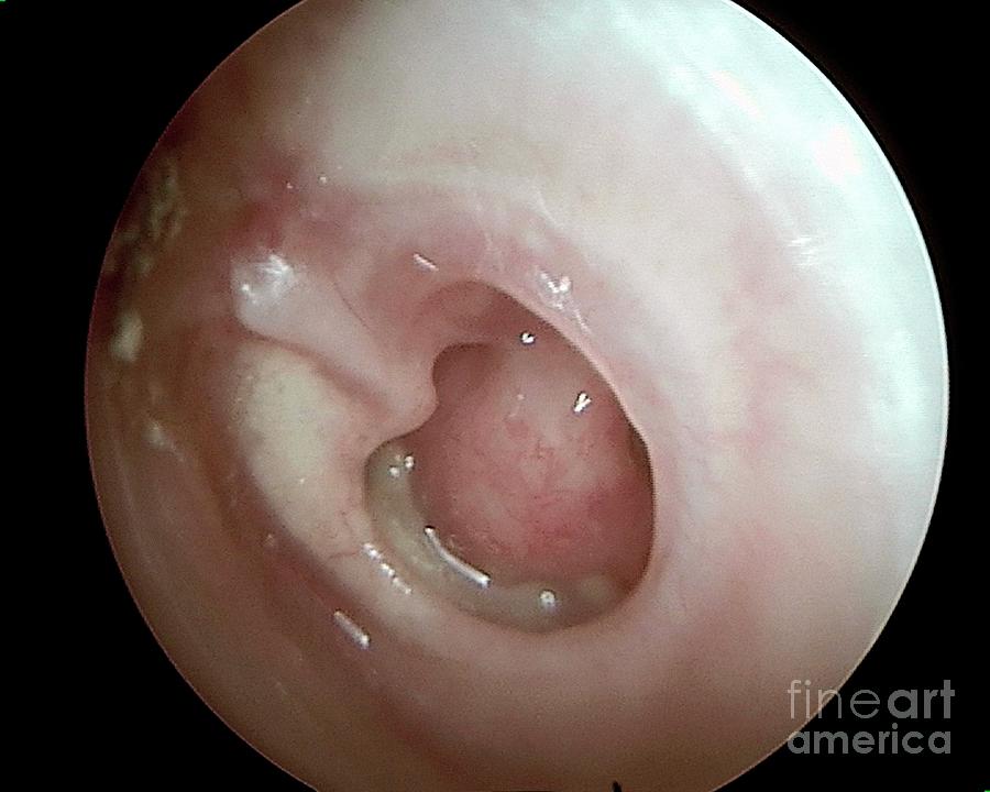 otoscope view ear infection