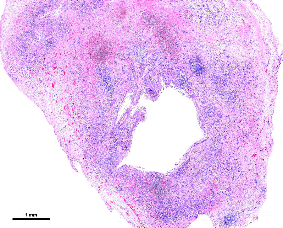 Periapical Cyst Photograph by Jose Calvo/science Photo Library - Pixels