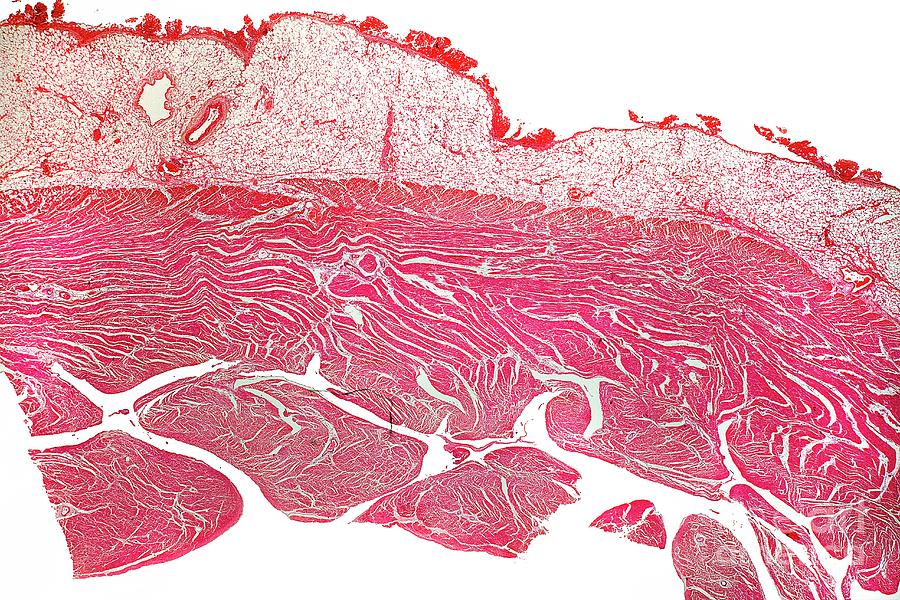 Pericarditis Photograph by Dr Keith Wheeler/science Photo Library