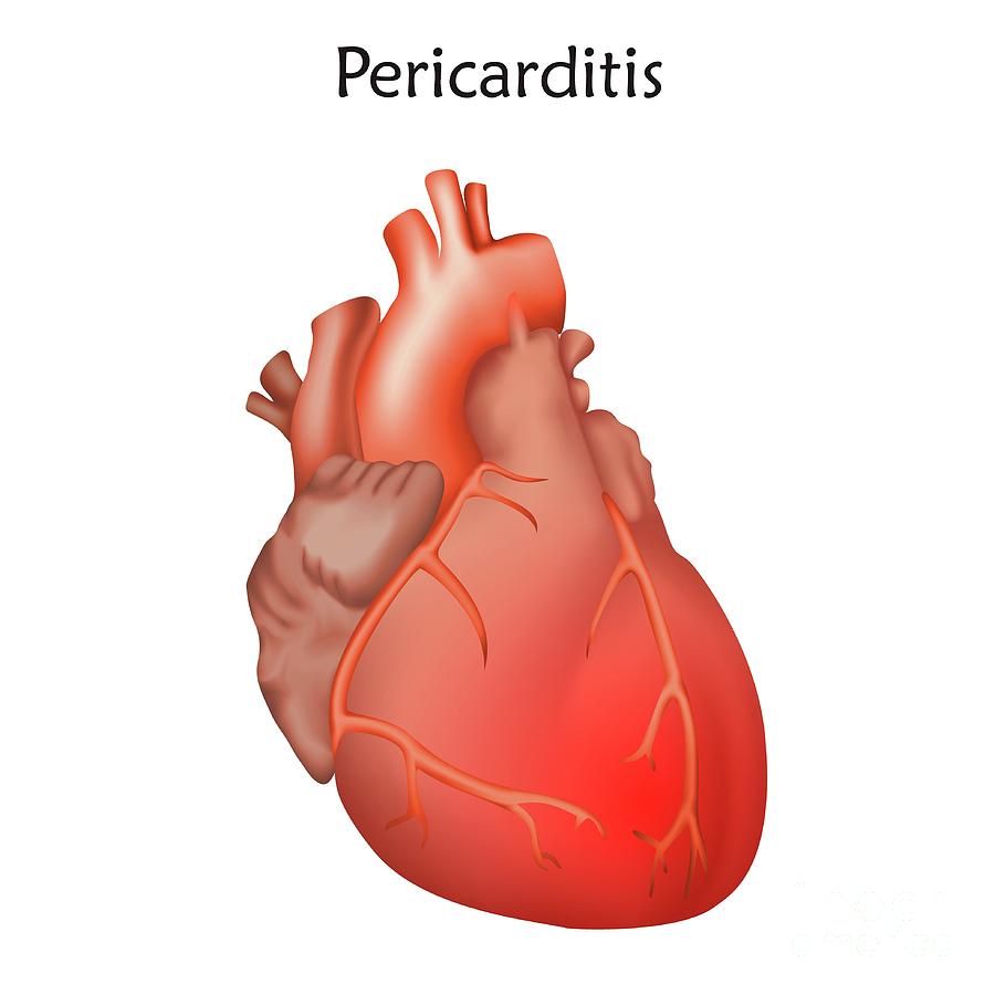 pericarditis-photograph-by-veronika-zakharova-science-photo-library