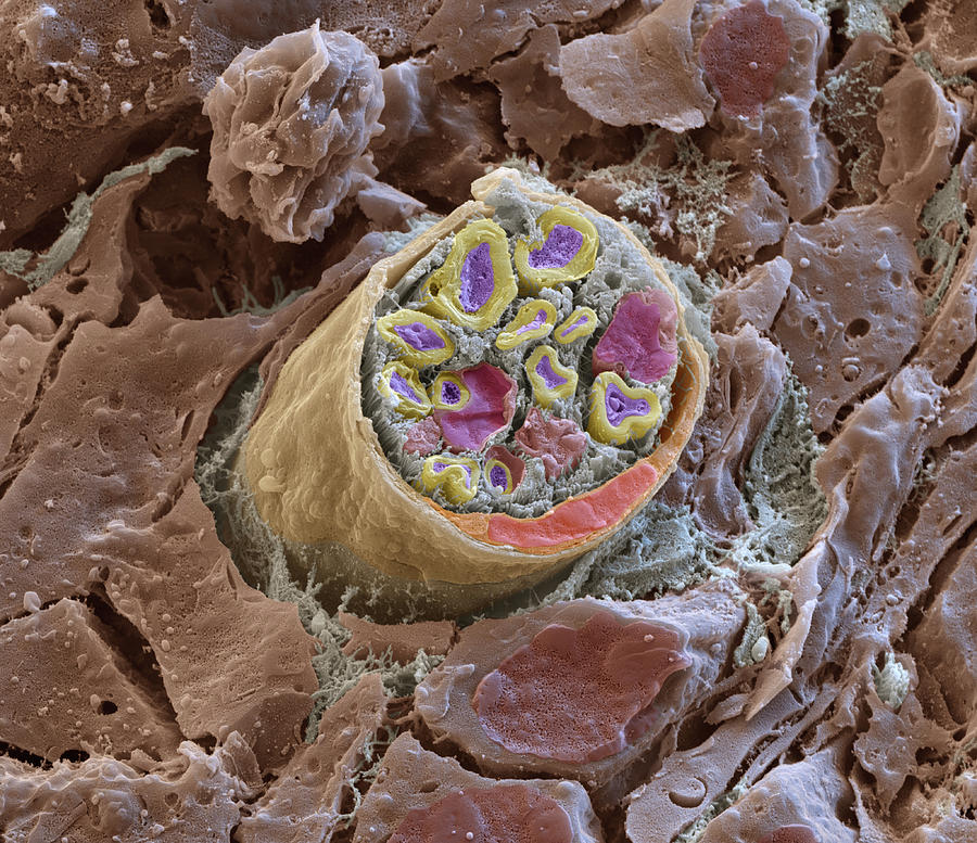Peripheral Nerve Breakage, Sem Photograph by Eye Of Science