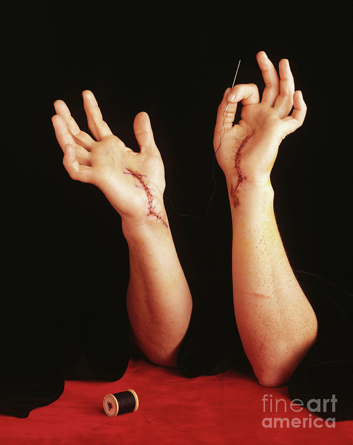 Person With Stitches On Hand, Holding Photograph by Tamara Staples