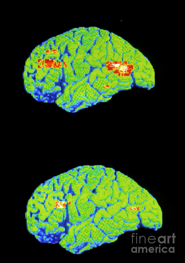 Pet Scan Of Depressed And Normal Brain Photograph by Wellcome Centre Human Neuroimaging/science Photo Library