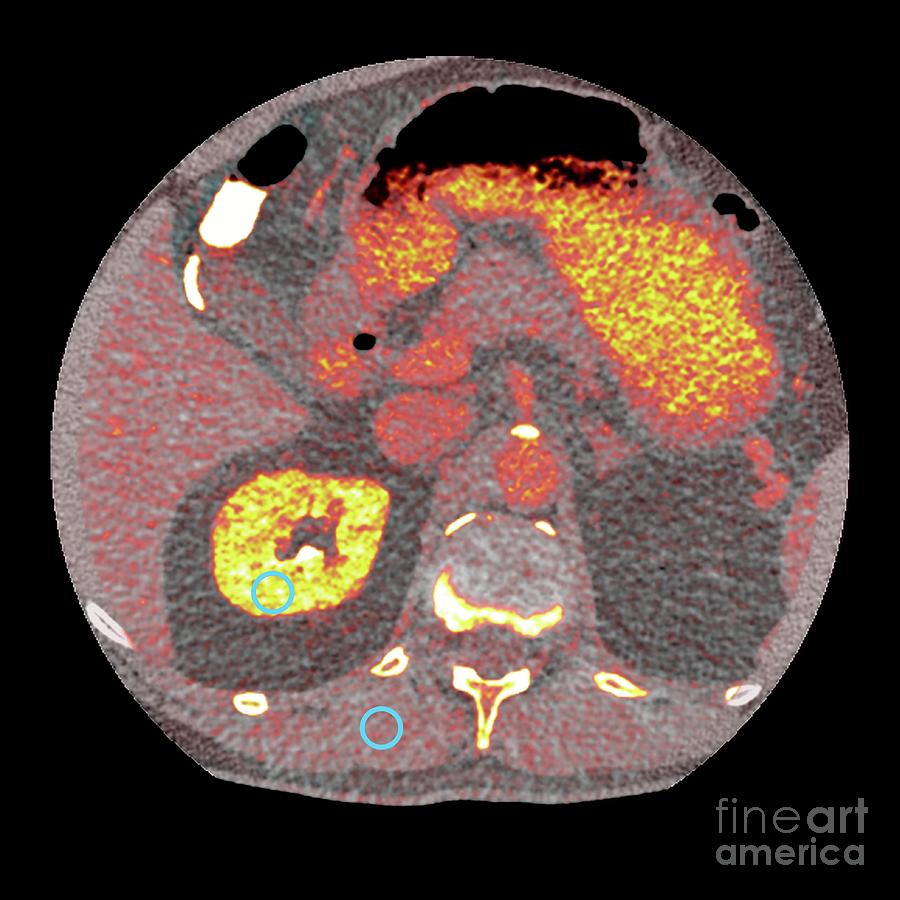 Photon-counting Ct Scan Photograph by Clinical Center, National ...