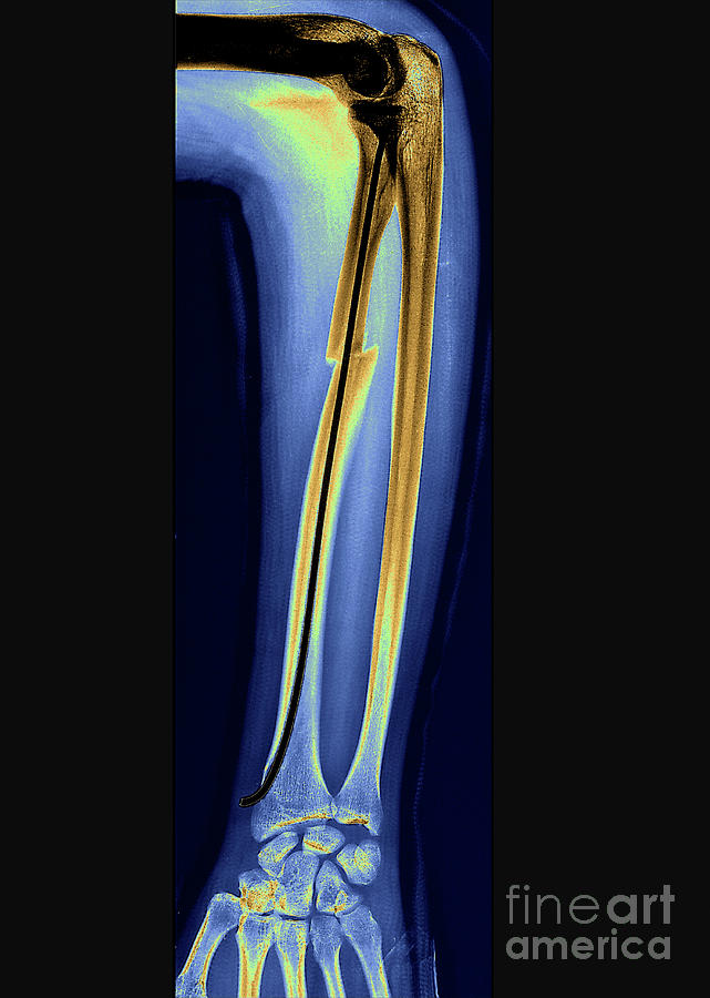 Pinned Fractured Radius Arm Bone Photograph by Zephyr/science Photo