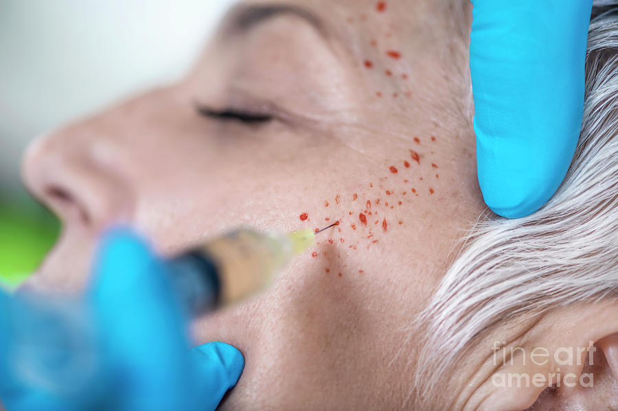 Prp Photograph - Platelet-rich Plasma Facial Treatment by Microgen Images/science Photo Library