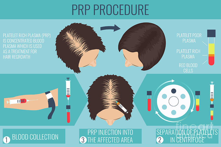 Platelet Rich Plasma Female Alopecia Treatment Photograph by Art4stock ...