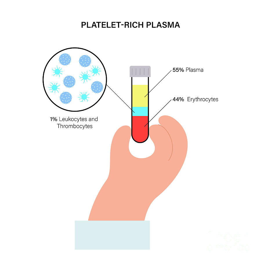 Prp Photograph - Platelet Rich Plasma by Pikovit / Science Photo Library