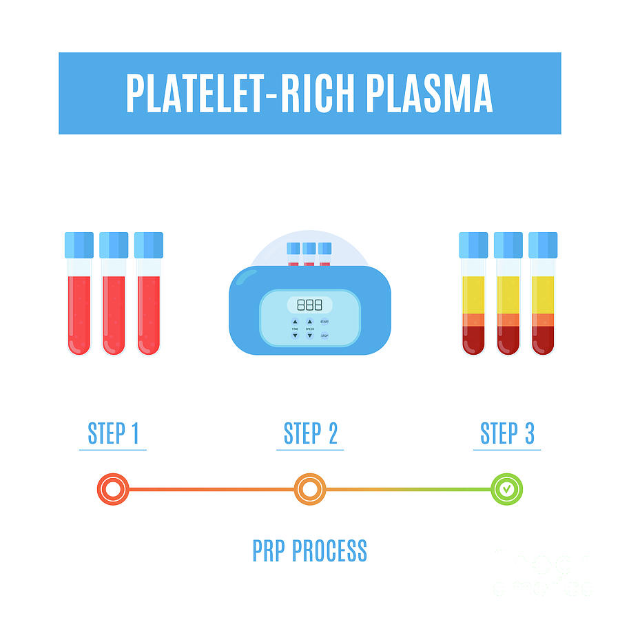 Platelet-rich Plasma Procedure Photograph by Art4stock/science Photo Library