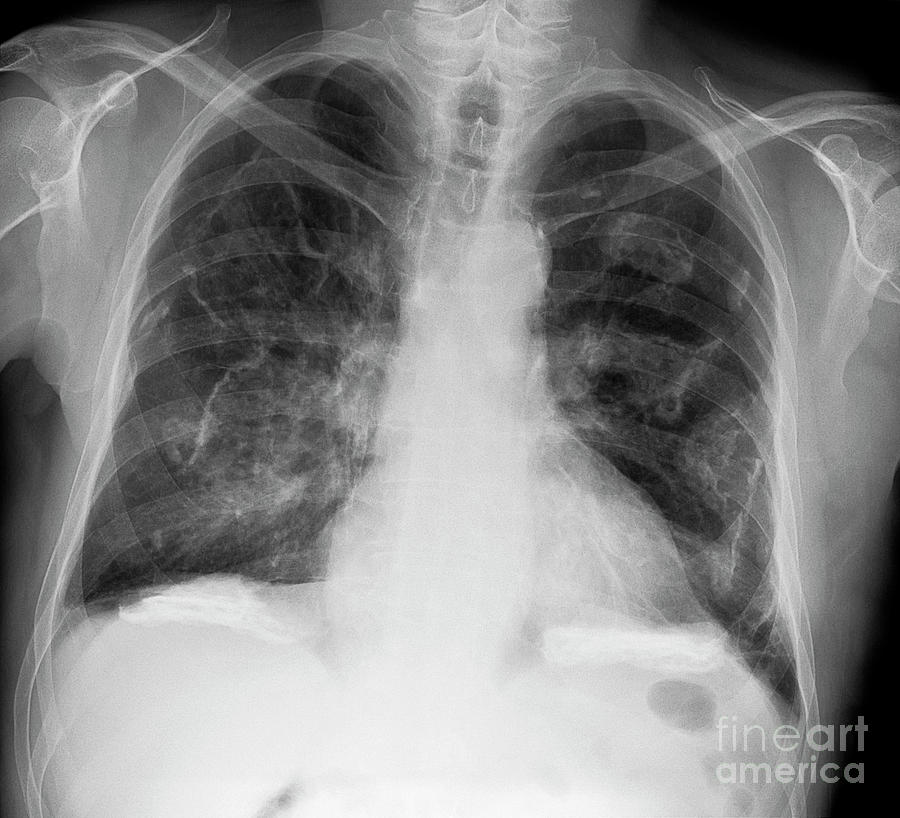 Pleural Thickening Due To Asbestos Photograph by Science Photo Library ...