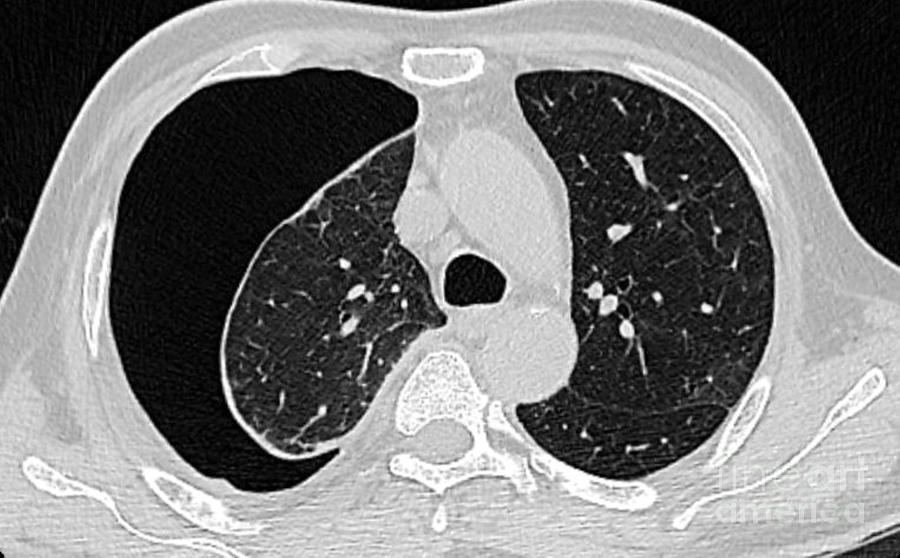 Pneumothorax Photograph by Rajaaisya/science Photo Library Pixels