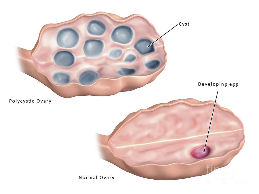 polycystic-ovaries-symptoms-diagnosis-treatment-ultrasound-and-diet