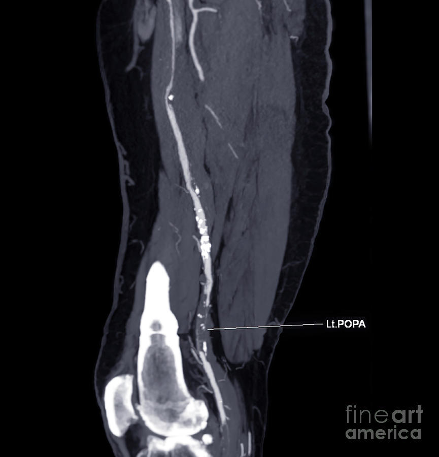 Popliteal Artery Photograph by Samunella/science Photo Library