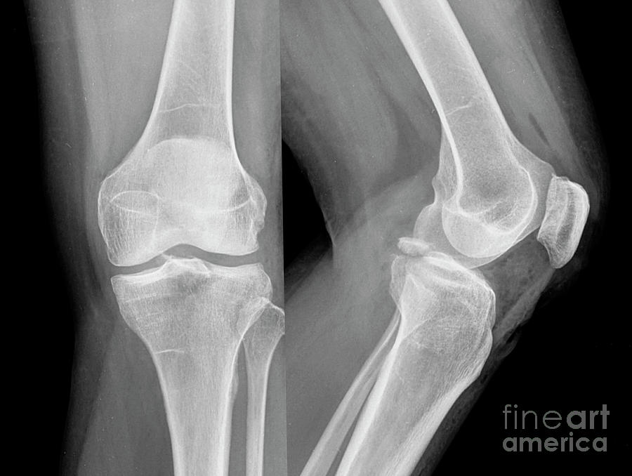 Posterior Cruciate Ligament Avulsion Fracture Photograph by Rajaaisya/science Photo Library