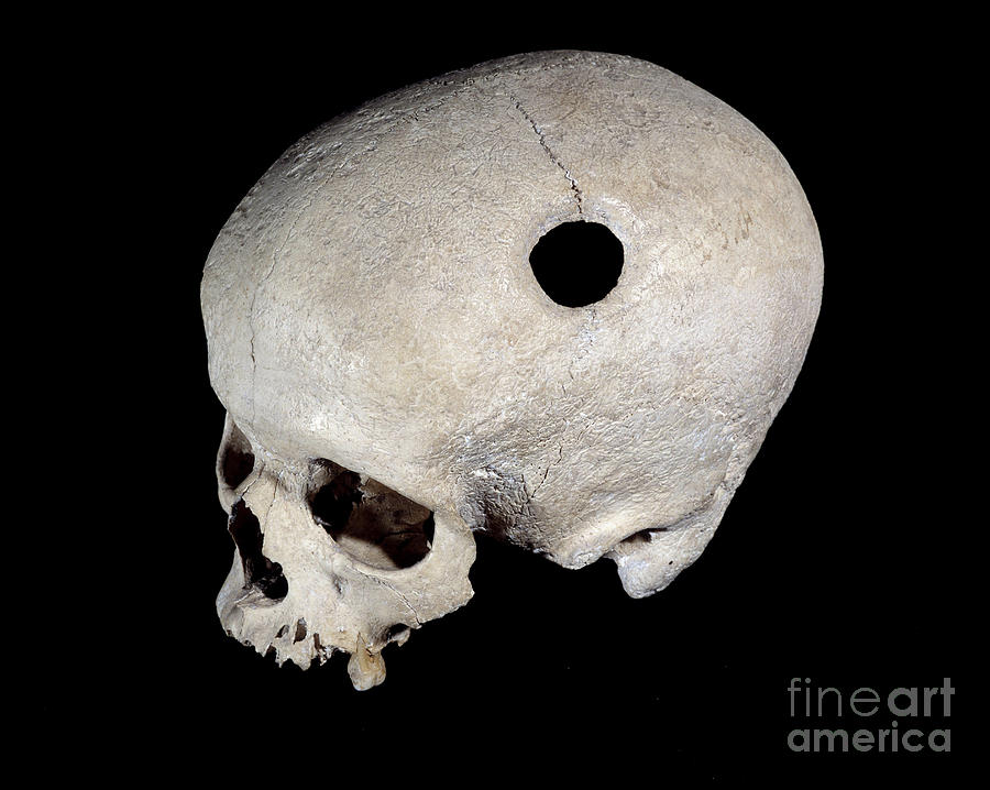 Skeleton Photograph - Prehistoric Skull With Trepanation Trace, Museum Of National Antiquities. by Prehistoric