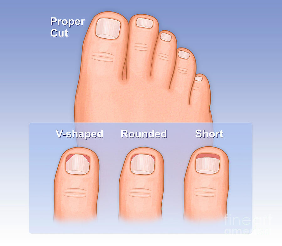 Proper Toenail Cutting Photograph By Medical Imagery Studios design 