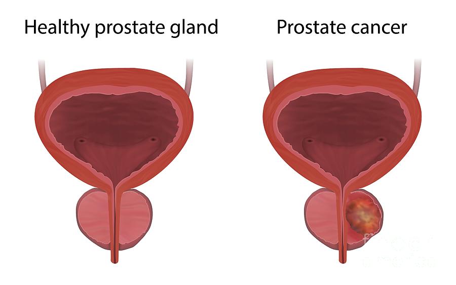 Prostate Cancer And Healthy Prostate Gland Photograph By Veronika Zakharovascience Photo Library 1150