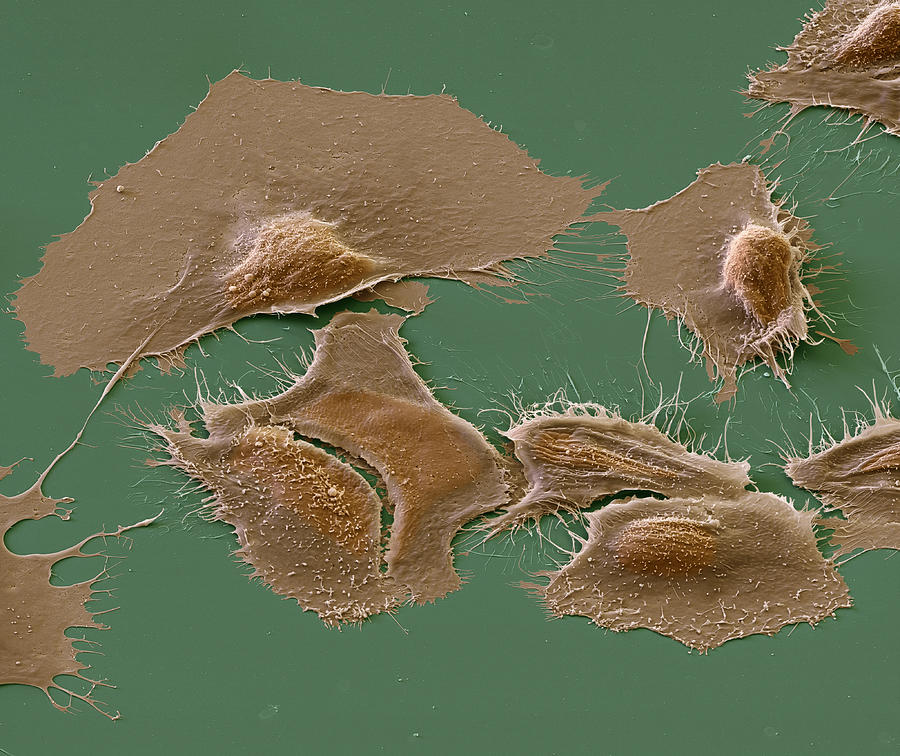 Prostate Cancer Cells, Sem Photograph by oliver MECKES/OTTAWA