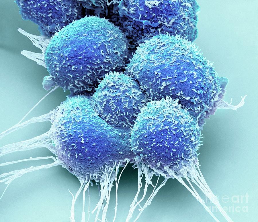 Prostate Cancer Cells Photograph By Steve Gschmeissnerscience Photo Library 6739