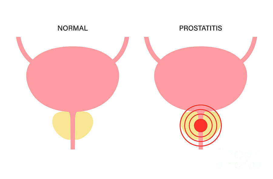 Prostatitis Photograph by Pikovit / Science Photo Library