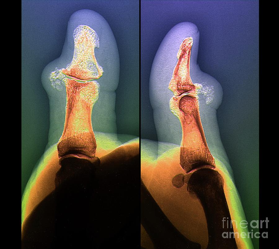 Pseudogout Of A Thumb Photograph by Zephyr/science Photo Library