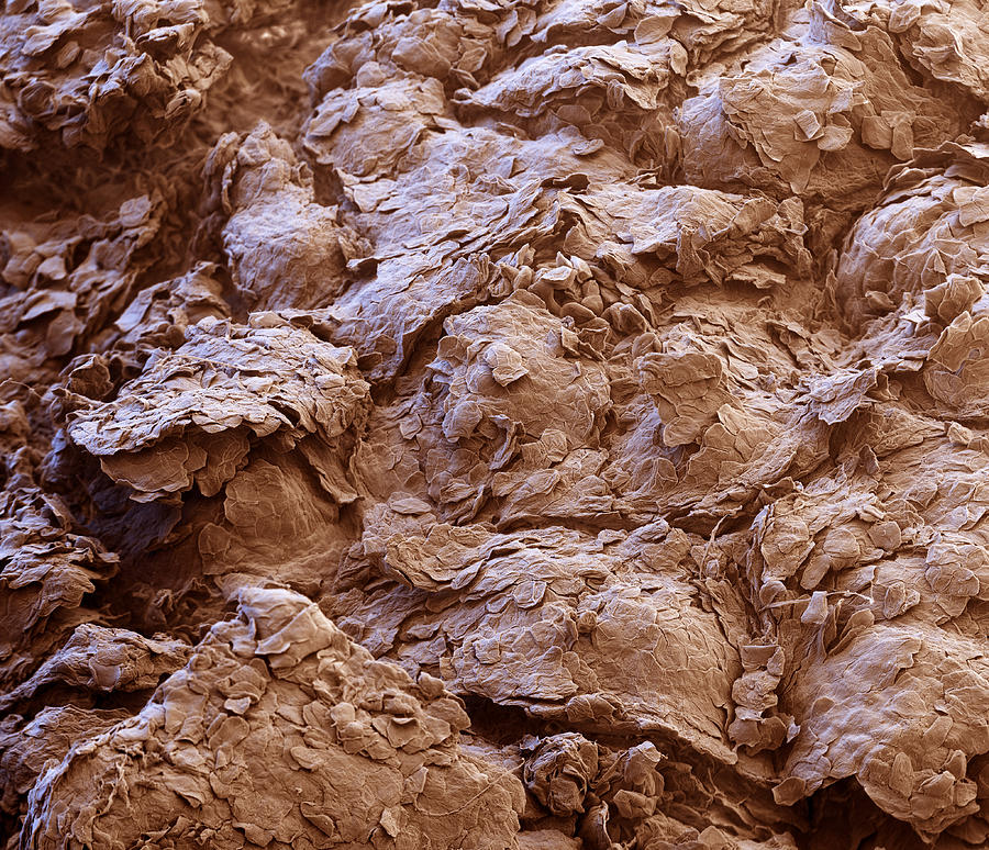 Psoriatic Skin With Yeast Infection, Sem Photograph by Meckes/ottawa