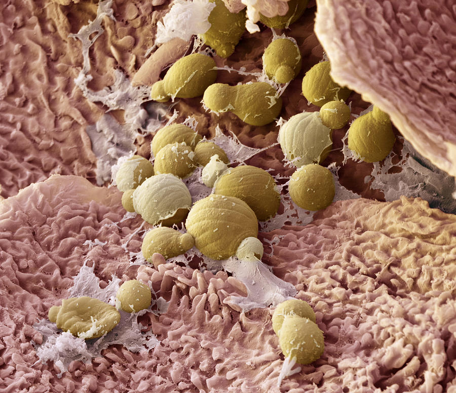 Psoriatic Skin With Yeast Infection, Sem Photograph by Oliver Meckes EYE OF SCIENCE